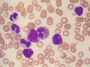 FDA宣布暂停销售白血病治疗药物ponatinib